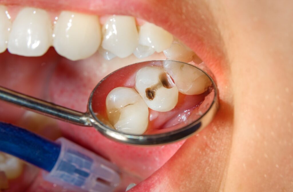 A close-up shot of a dental mirror reflecting a child's teeth with multiple cavities.