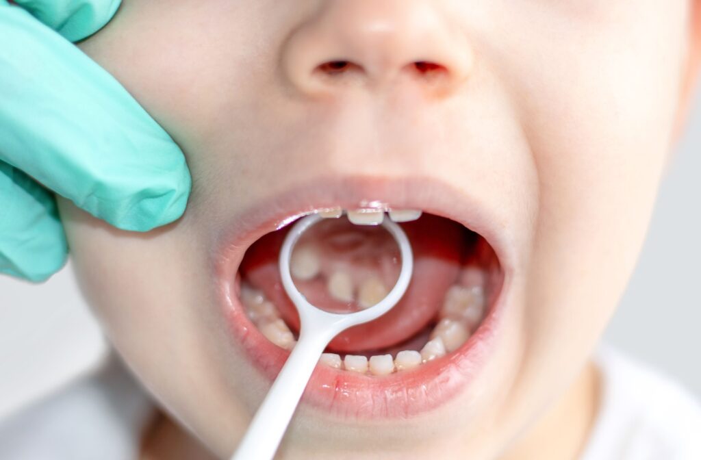 A close-up of a child's mouth as a dentist examines their teeth for cavities.